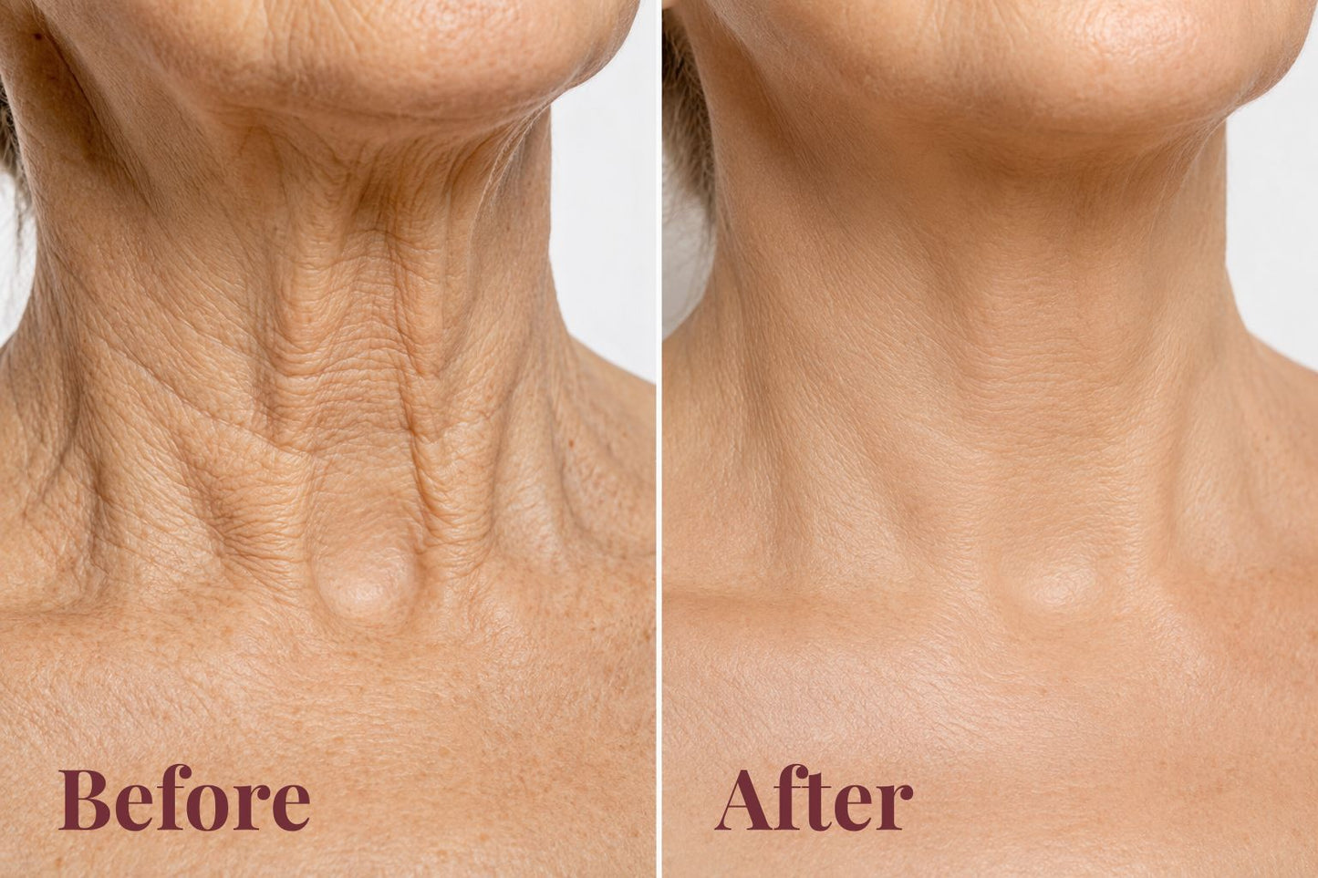 Toneva Anti-Aging Body Oil — Firms, Lifts & Restores Loose Skin